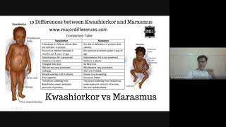 MARASMUS  CAUSES  SYMPTOMS  DIAGNOSIS  TREATMENT  MALNUTRITION IN CHILD in hindi [upl. by Buffum]