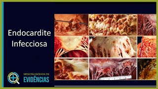 Endocardite Infecciosa  Aula [upl. by Dosh]