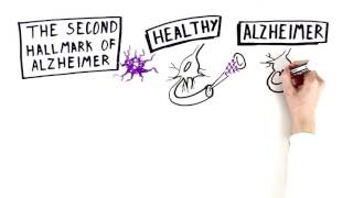 Rapid Progression of Alzheimers [upl. by Ritch]