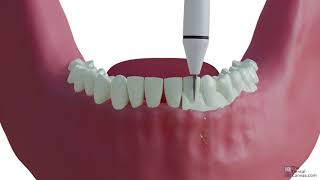 Scaling  Dental Procedures [upl. by Ardnaik]