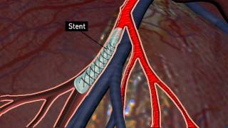 You and Your Stent [upl. by Tubb]