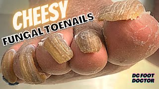 Cheesy Fungal Toenails Trimming Long Toenails [upl. by Walczak]