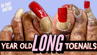 Year Old Long Toenails Trimming Extremely Long Toenails [upl. by Pik]