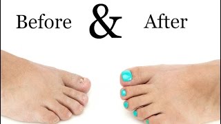 Toenail Treatment  Miracle Gelous Reconstruction [upl. by Barb]