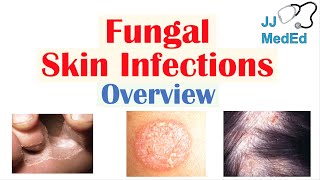 Overview of Fungal Skin Infections  Tinea Infections [upl. by Laeahcim957]