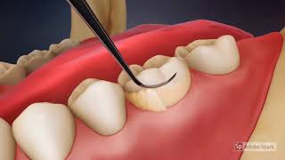 Video Tutorial Dental Scaling [upl. by Attikin]