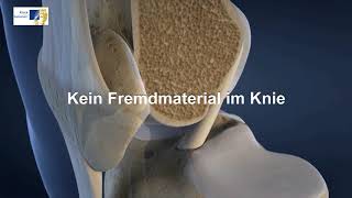 Knie OP bei Kreuzbandriss  3DAnimation Kniegelenk [upl. by Aneel740]