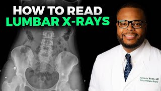 How to Read a Lumbar XRay [upl. by Inoy]