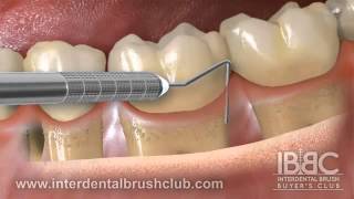 Periodontal disease causes and treatment [upl. by Seafowl804]