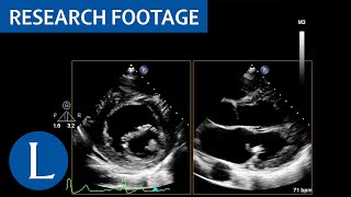 Mass attached to base of the posterior leaflet of the mitral LibmanSacks endocarditis 2 of 4 [upl. by Arvell]