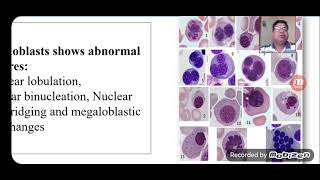 Bone Marrow Examination  Aspiration amp Biopsy [upl. by Cohby841]