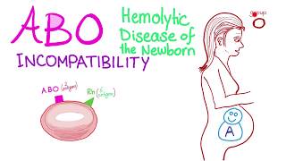 ABO Incompatibility  Hemolytic Disease Of The Newborn HDN  Hematology amp Pathology [upl. by Skip]