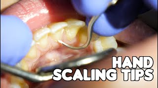 Dental Cleaning  Hand Scaling Tips [upl. by Gabrila]