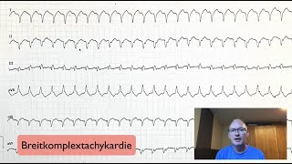 ECG Rhythm Review Ventricular Tachycardia Torsades de points Asystole [upl. by Reamonn254]