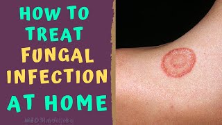 HOW TO TREAT SKIN FUNGAL INFECTION INFECTION AT HOME TINEA RINGWORM REMEDIES HOW TO CURE [upl. by Middendorf]