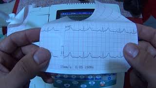 Tutorial ecg1200g contec electrocardiografo [upl. by Tsugua]