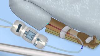 Interpreting Arterial Pressure Waveforms by J DiNardo  OPENPediatrics [upl. by Huppert]