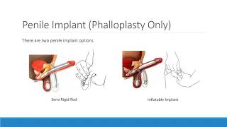 Phalloplasty Exploring Your Options [upl. by Bessy]