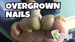 Overgrown Toe Nails [upl. by Noremak]