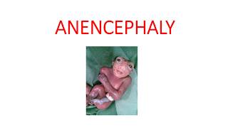 ANENCEPHALY [upl. by Damita]