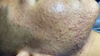 Acne Treatment For quotHungquot P4  Điều Trị Mụn Cho Hùng P4  SacDepSpa189 [upl. by Ilek]